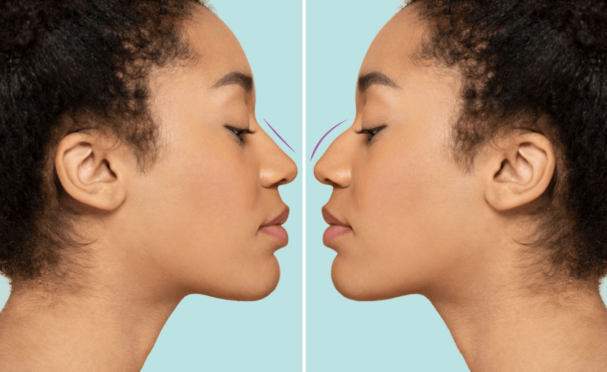 Rhinoplasty