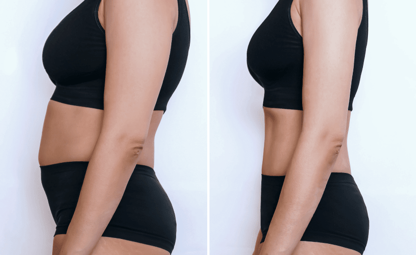 Liposuction